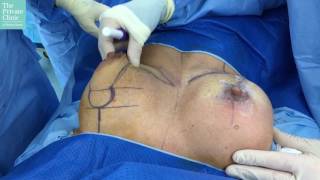 Bilateral Mastopexy & example of Prineo Surgical Tape