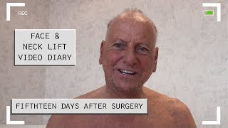 Face and neck lift video diary - 15 days after surgery (13/13)