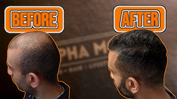 18 month Finasteride, Minoxidil and ru58841 transformation - hair loss reversal