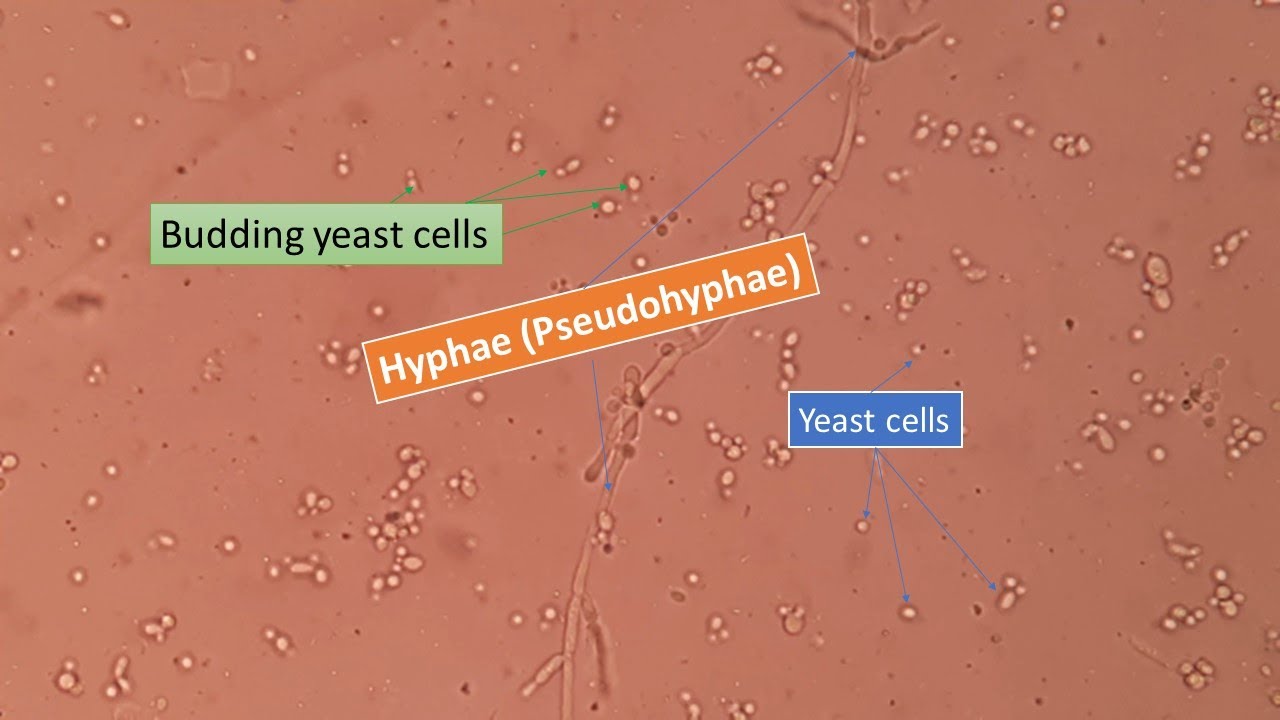 KOH mount of sputum under the Microscope showing fungal elements yeast