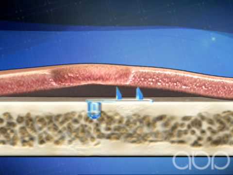 Brow Lift - Cosmetic Surgery - 3D Medical Animation || ABP © - YouTube