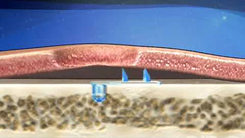 Brow Lift - Cosmetic Surgery - 3D Medical Animation || ABP ©