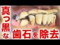 真っ黒な歯石を除去 Remove black TARTAR 歯石Vol.5(去除全黑的牙石)Plaque