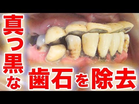 歯石 取れ た 黒い