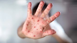 3 new measles cases tied to patient from Georgia State University Wealth