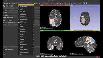 3D Slicer: Brain Tumor Segmentation using Deep learning
