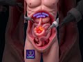 Ventral Hernia Repair Surgery Causes Procedure Recovery Explained Ventral Hernia Repair Surgery Causes Procedure Recovery Explained