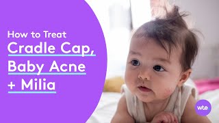 How to Treat Your Baby's Acne, Cradle Cap and Other Rashes (Plus, Why It Happens!) - What to Expect