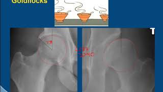 MRI Hip Imaging of Femoral Acetabular Impingement screenshot 4