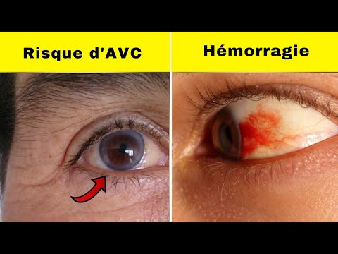 Voici les Choses que vos Yeux peuvent vous Dire sur votre Santé