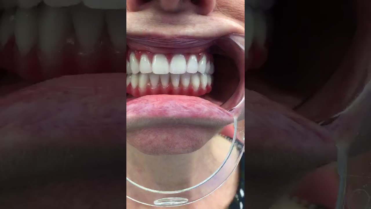 All on 4 / All on four - все зубы на 4 имплантах за 1 день. Неватекс отзывы пациентов