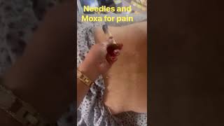 Technique to release body pain is Acupuncture and moxa. #follower #pain #acupuncture #reel #health