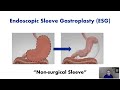 Endoscopic Sleeve Gastroplasty (ESG) -- Procedure Overview