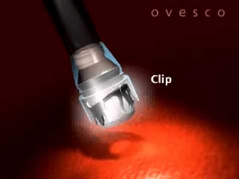 The OTSC (Over-The-Scope Clip) System from Ovesco 