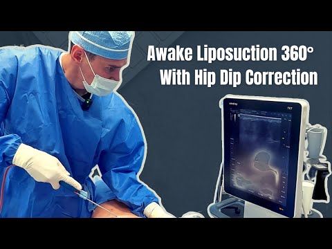 Awake Liposuction 360° With Hip Dip Correction. Dr. Alexey Markelov of AM Plastic Surgery.