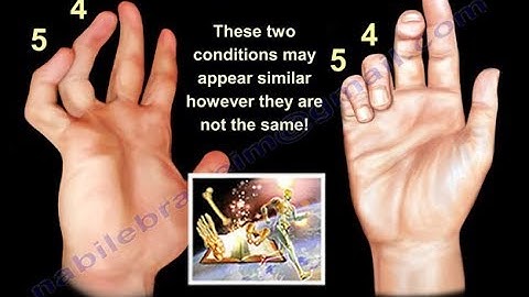 Claw Hand, Ulnar Claw Hand - Everything You Need To Know - Dr. Nabil Ebraheim