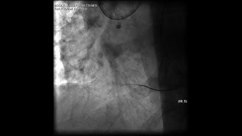 Aortic dissection and radial rupture during retrograde CTO PCI: Management of complications VİDEO 9