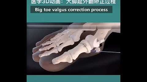 senthmetic|Big toe valgus correction process