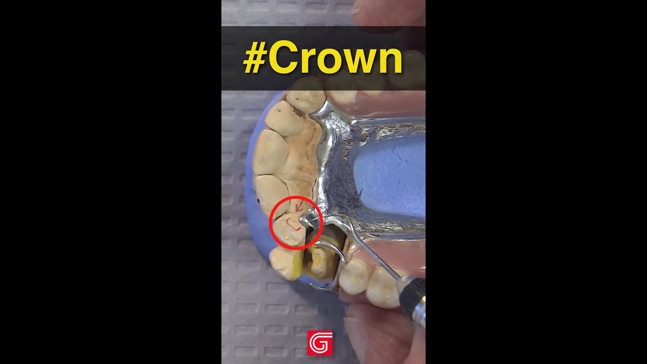 Creating a Crown Underneath a Partial Denture Dentistry Dental Dentist shorts YouTube