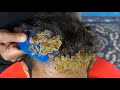 BIG FLAKES !! - Scratching scalp and picking - satisfying dandruff removal #159