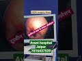 #Fess surgery #endoscopic surgery nose#नाक के दूरबीन से ऑपरेशन #avanihospitaljaipur