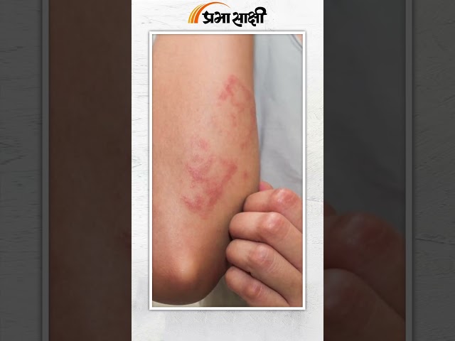 itchy skin | खुजली से छुटकारा दिलाते हैं ये घरेलू उपचार | Prabhasakshi