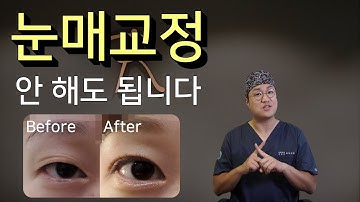 눈매교정 안해도 되는 눈.  눈매교정 없이 눈이 커질 수 있음에도 눈매교정술을 권유받기 쉬운 눈의 형태와 누구나 쉽게 그 여부를 판단할 수 있는 기준을 알려드릴게요.