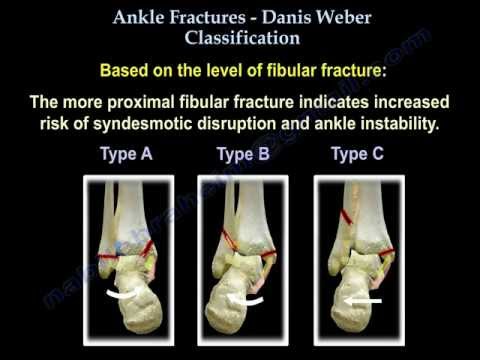 Ankle Fractures. There are many of important topics…, by Nabil Ebraheim, Thrive Global