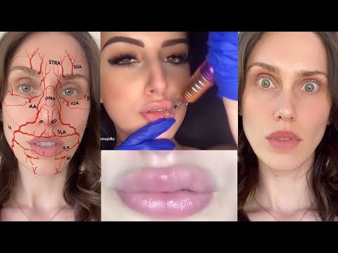 Video: Subscribers Admired How Zhanna Epple Looks After Beauty Injections