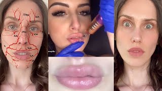 🛑   These DIY Lip Fillers Need To Be Stopped | Dangerous Tik Tok Trends &: Hyaluron Pens