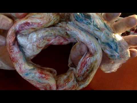 Video: Pigmentne Retiniidi Ravi Whartoni Tarretisest Saadud Mesenhümaalsetest Tüvirakkudest: Esialgsed Kliinilised Tulemused