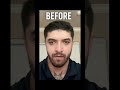 7 Month Surgery Transformation