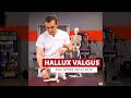 Hallux Valgus | Халюс Вальгус или косточка на стопе, что делать?