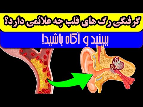 تصویری: آیا ekg عروق مسدود شده را نشان می دهد؟