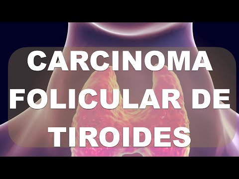 Vídeo: Què és un carcinoma fol·licular de tiroides?