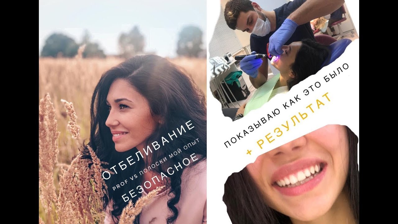 Отбеливание безопасное! Проф vs полоски Реальный опыт + результат