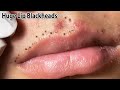 Removes a lot of blackheads on upper and lower lips | Satisfaction and Relaxation Videos 2024 | Tips