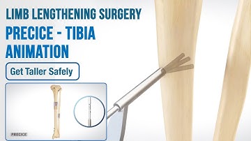 PRECICE - Tibia Animation