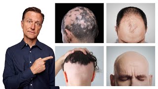各類掉髮,頭髮稀疏,雄性禿,7種自然療法,柏格醫生 Dr Berg