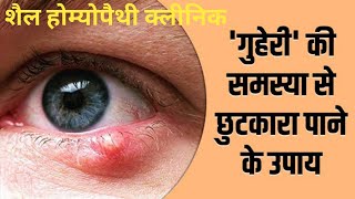 stye eye treatment | ऑंख की गुहेरी का इलाज | homeopathic medicine for stye eye #shorts