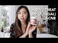 HOW I TREAT MY ACNE & FUNGAL ACNE