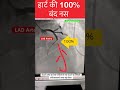 100% बंद नस l Heart attack blocked artery l #echo #angiography #shorts