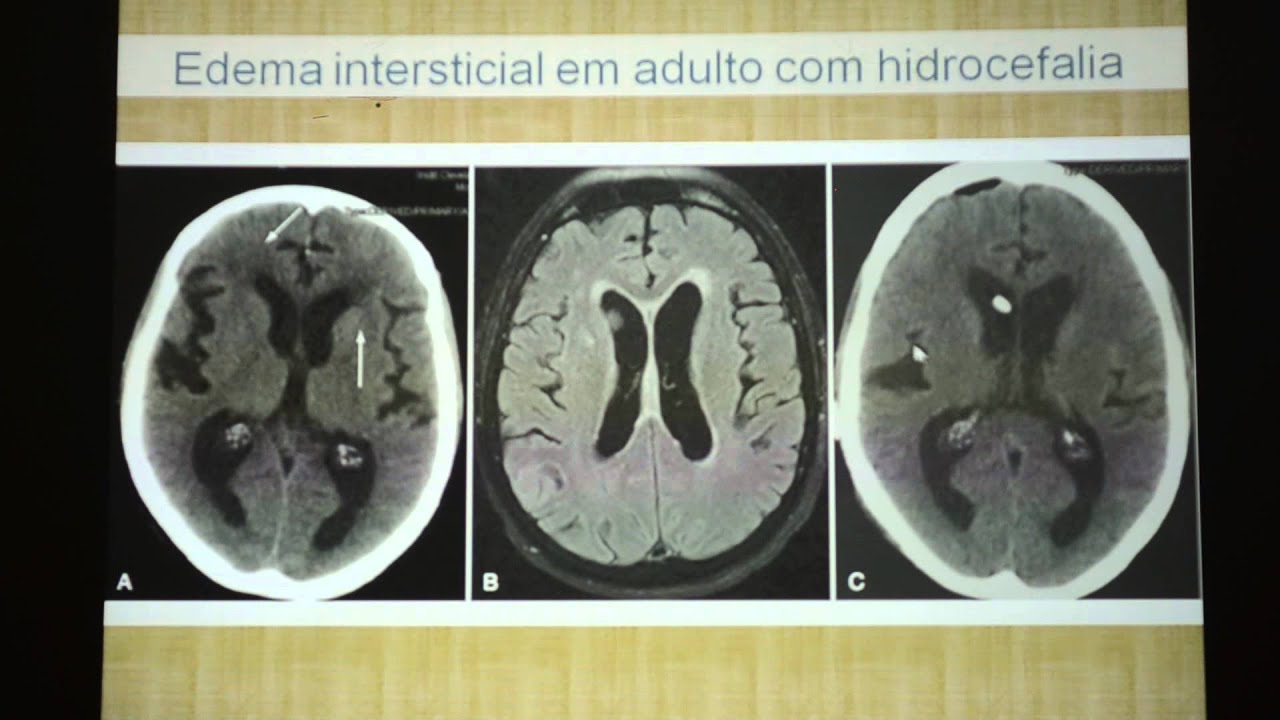 Edema Cerebral - parte 2 - YouTube