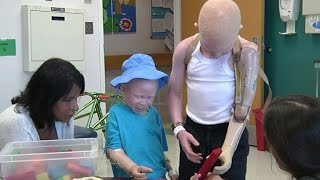 African children with Albinism targeted by poachers
