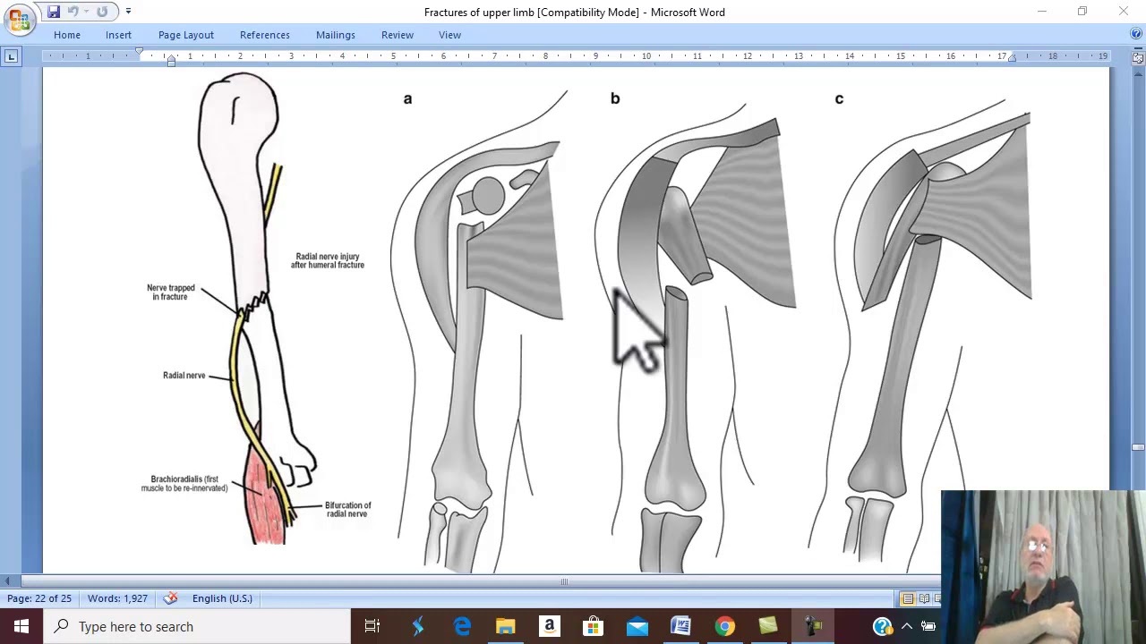Orthopedic  in Arabic 14 ( Fracture shaft of humerus ) , by Dr. Wahdan