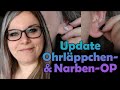 UPDATE: Wie sehen meine Narben nun aus? Update zu Ohrläppchen-OP und Narbenentfernung 2018