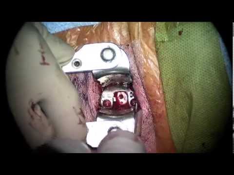 VERTEVIEW® And REBAR®: Anterior Cervical Discectomy And Fusion (ACDF) LIVE - Atlas Spine