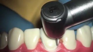 Реставрация зубов, подготовка переднего зуба, установка виниров(http://www.liderstom.ru/restavratsiya-zubov/, 2016-04-20T19:02:44.000Z)