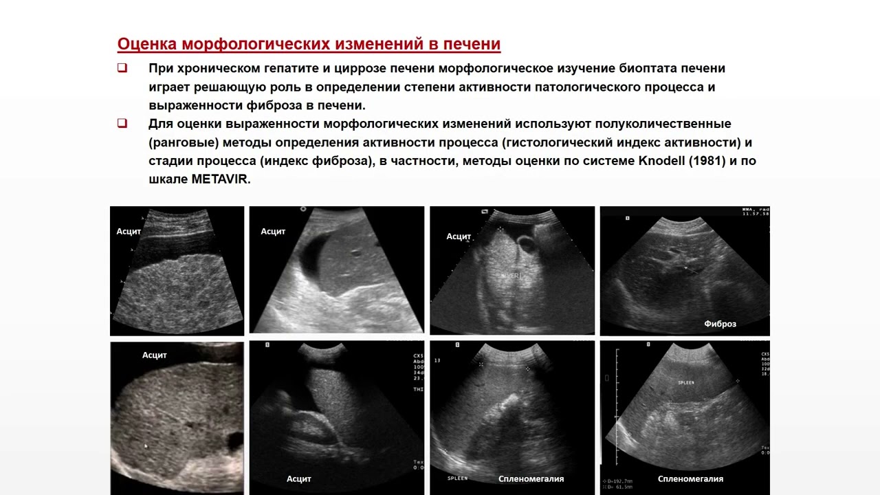 Диффузные изменения печени на УЗИ. Диффузные изменения печени мкб. Фиброзные изменения печени