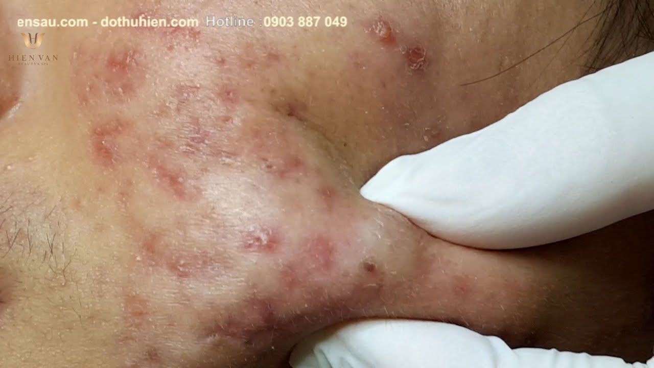 Remove and Clean many Cyst in younger at hien van spa|344|Tiến Hưng